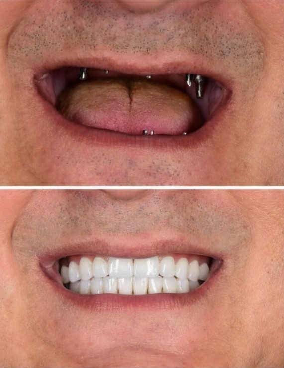 Complete full mouth dental reconstruction and rehabilitation