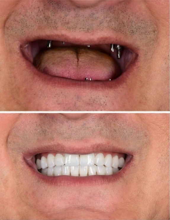 Permanent affordable dental implants for missing teeth in Sector 88