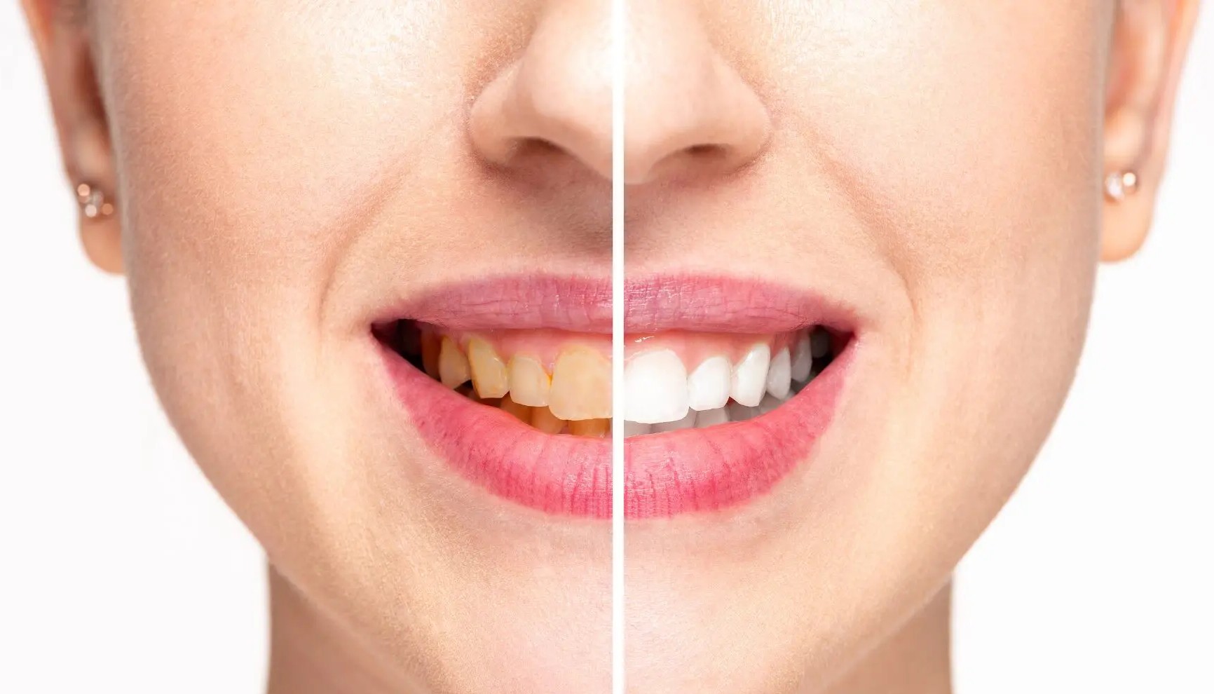 Professional clinical teeth whitening and bleaching at My Dentist